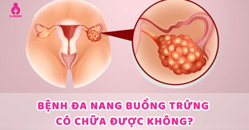 Giải đáp: Bệnh đa nang buồng trứng có chữa khỏi được không​?