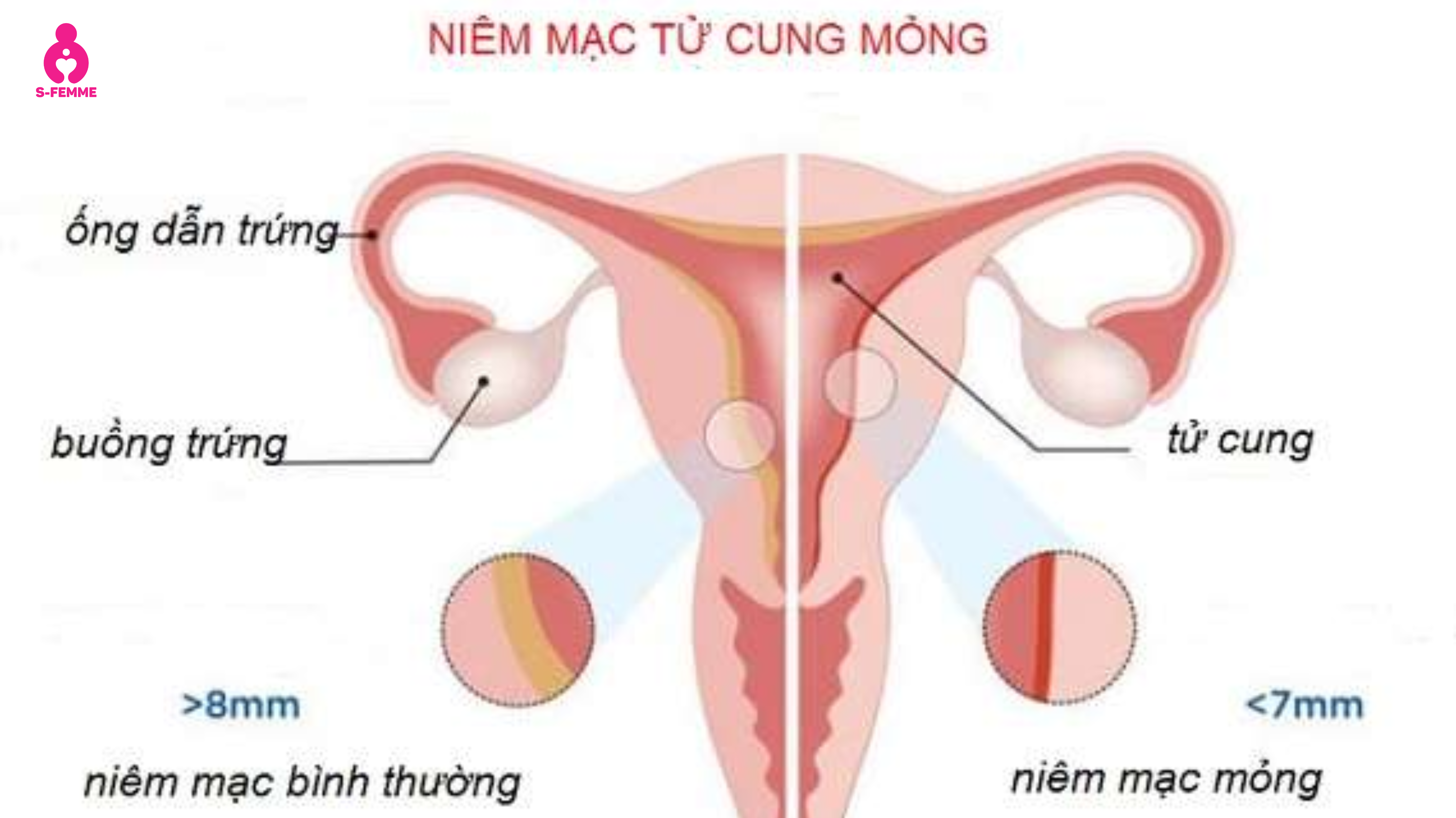 Niêm mạc tử cung mỏng là gì