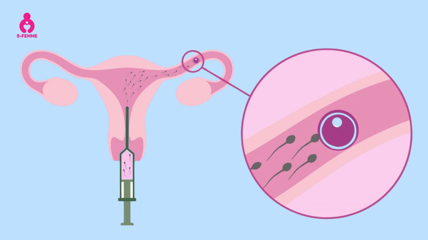 IUI là phương pháp hỗ trợ sinh sản cho người bị đa nang buồng trứng hiệu quả