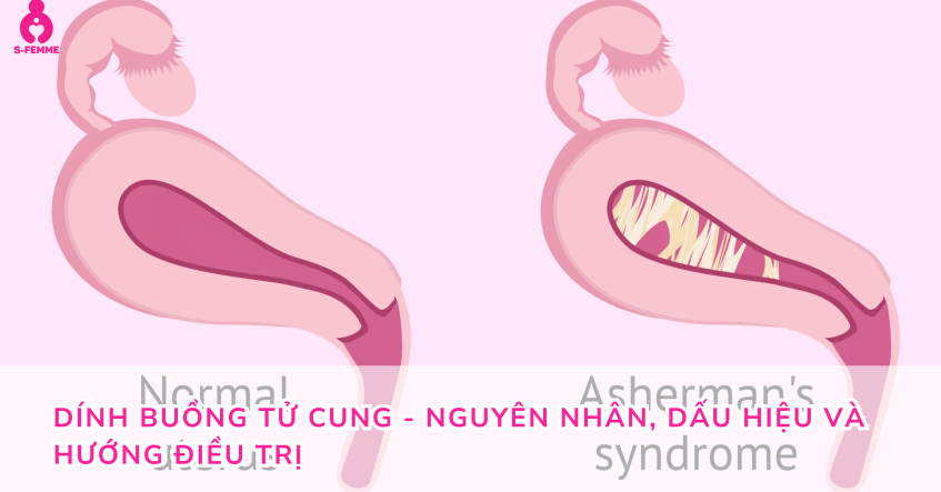 Dính buồng tử cung - Nguyên nhân, dấu hiệu và hướng điều trị 