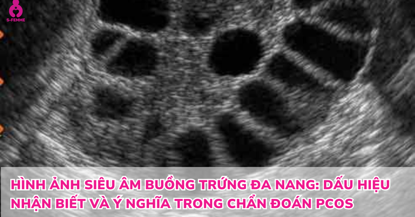 Hình ảnh siêu âm buồng trứng đa nang: Dấu hiệu nhận biết và ý nghĩa trong chẩn đoán PCOS