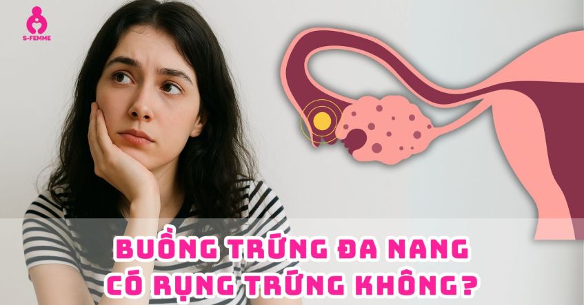 Giải đáp: Buồng trứng đa nang có rụng trứng không​?