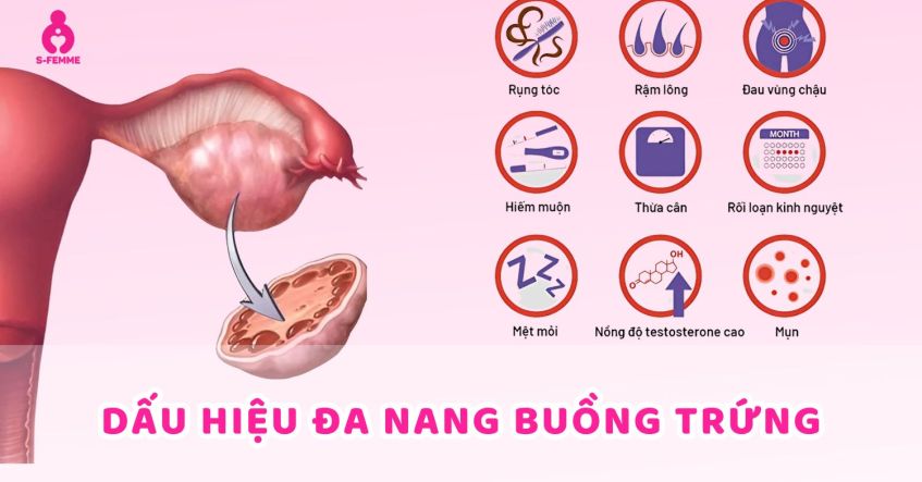 Dấu hiệu đa nang buồng trứng​ điển hình ở nữ giới