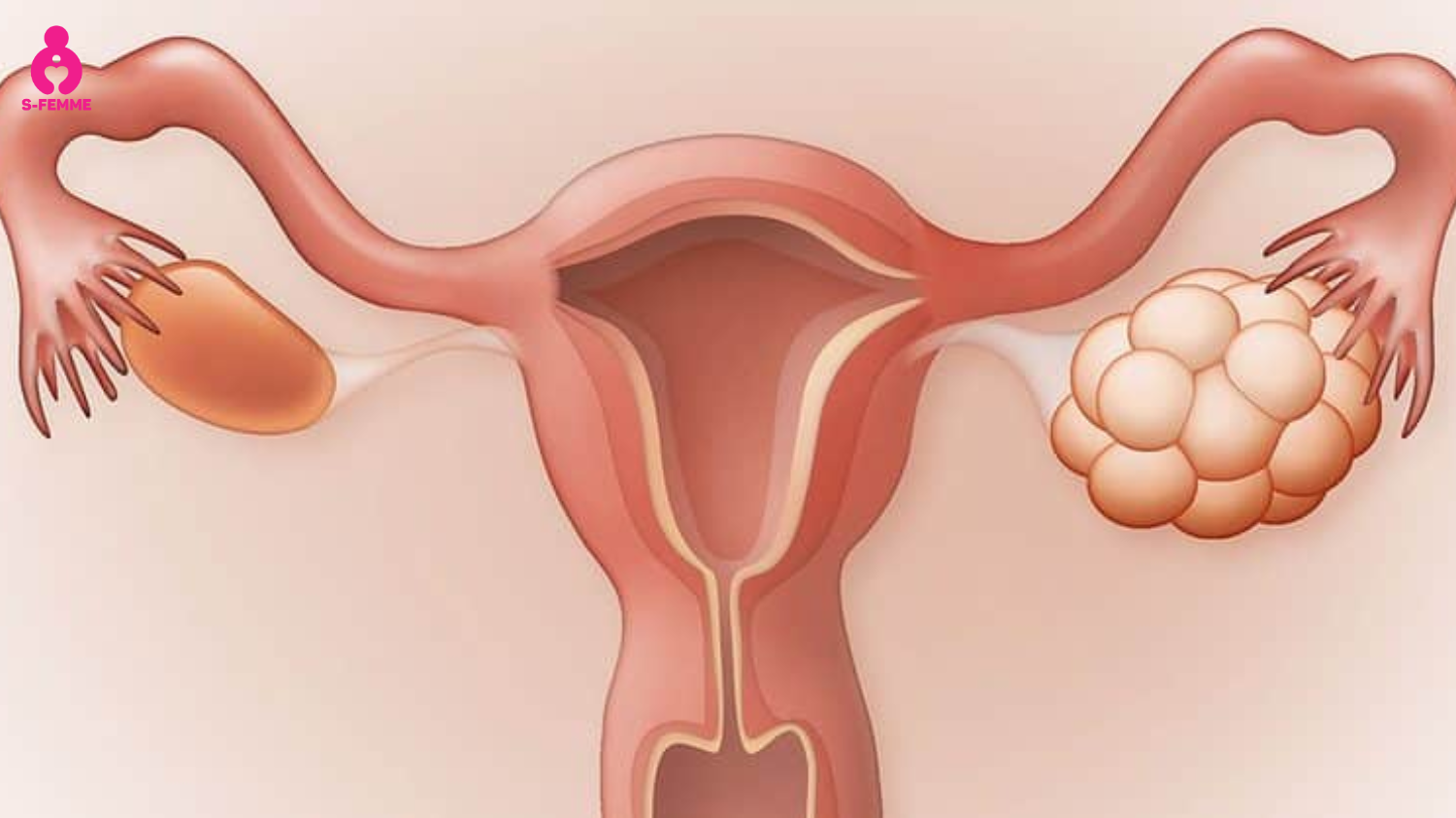 Quá kích buồng trứng có nguy hiểm không