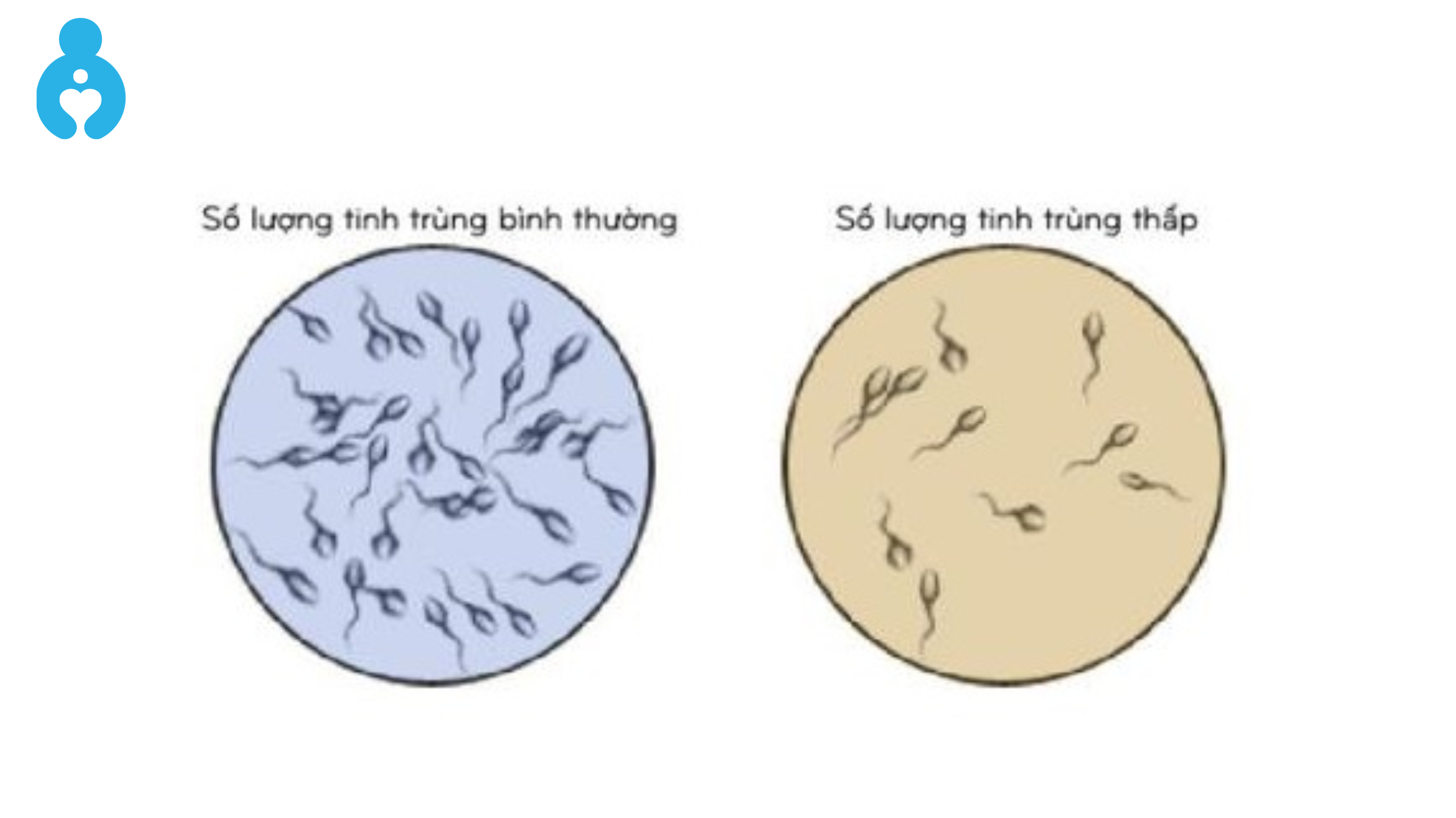 Tinh trùng ít và loãng là gì