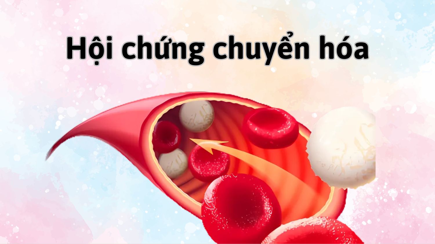 Hội chứng chuyển hóa ở PCOS làm tăng nguy cơ tim mạch