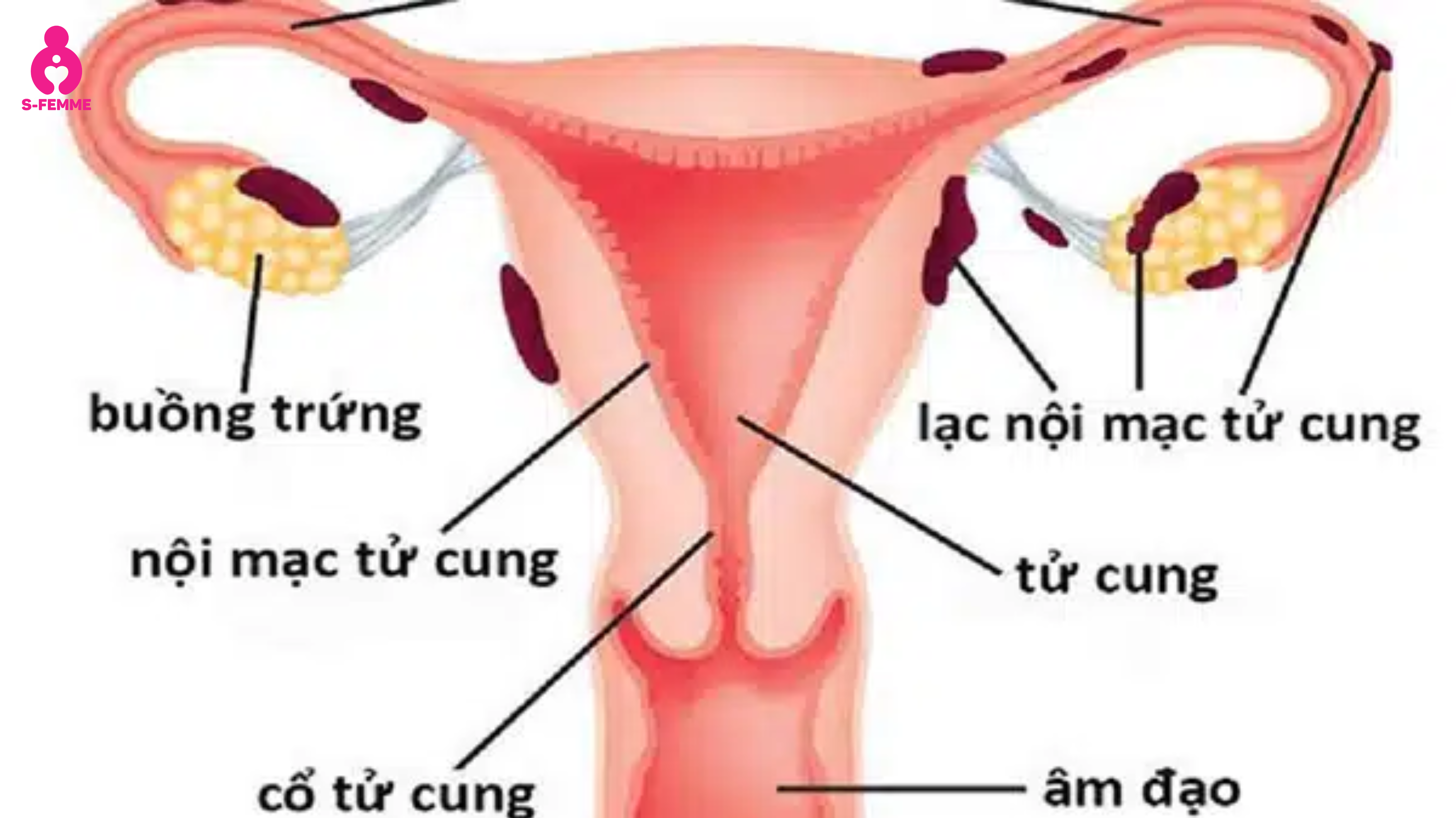 lạc nội mạc tử cung là gì