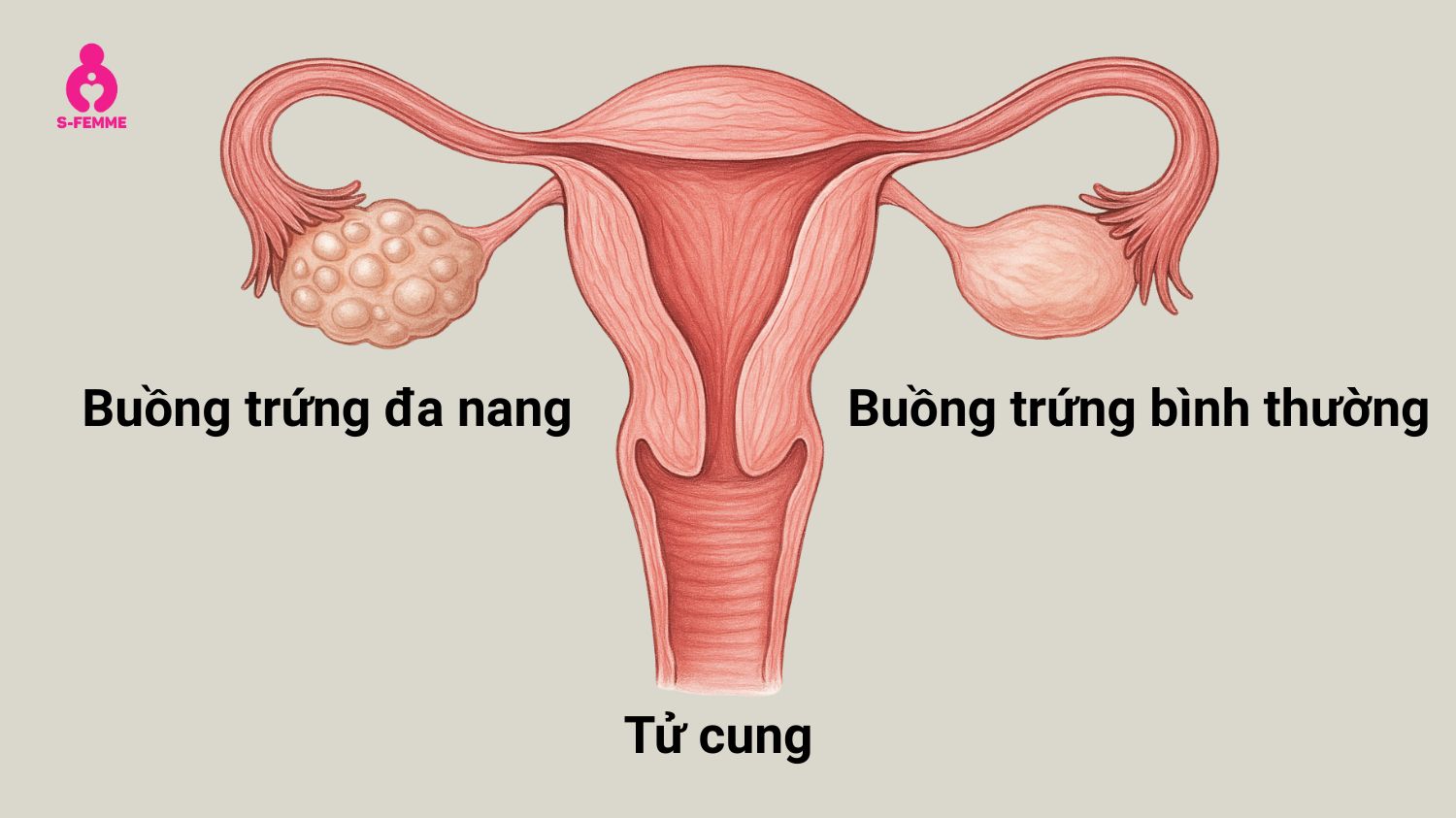 Hội chứng buồng trứng đa nang (PCOS) là nguyên nhân gây vô sinh phổ biến ở nữ giới