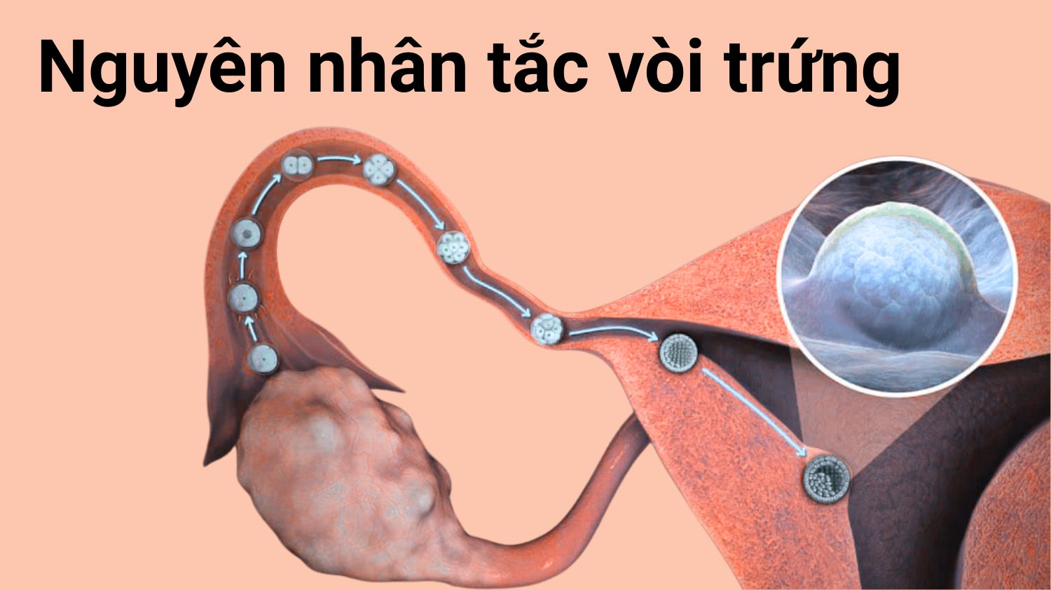 Nguyên nhân tắc ống dẫn trứng