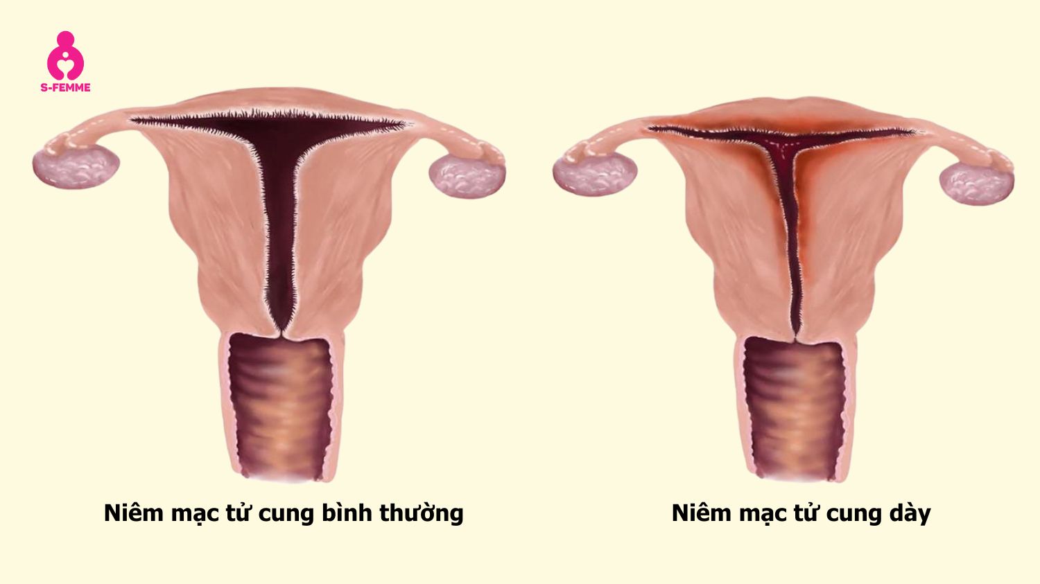 Niêm mạc tử cung dày là một trong những dấu hiệu bất thường