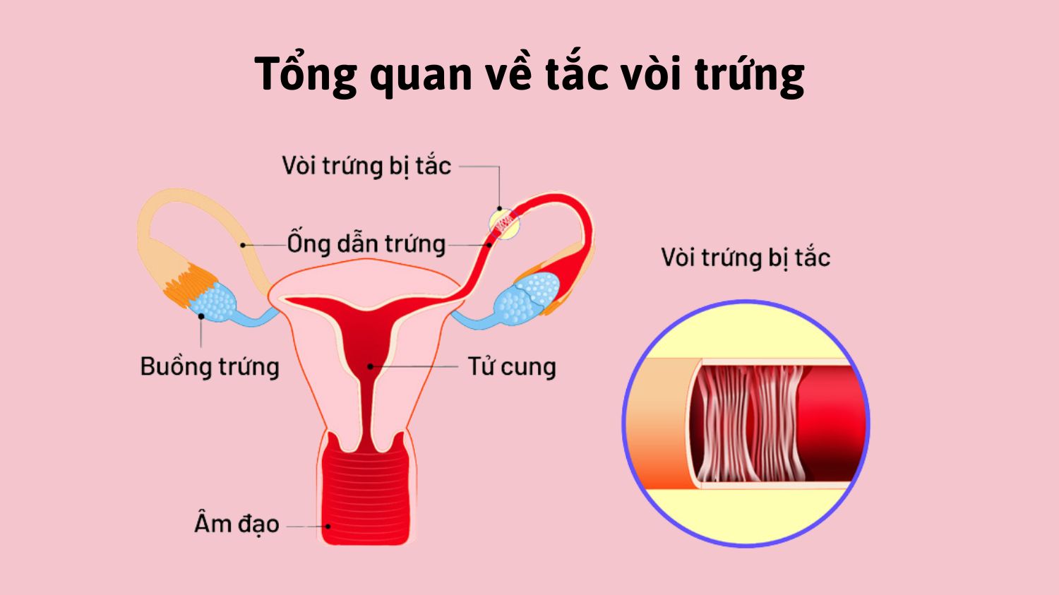 Tổng quan về tắc vòi trứng