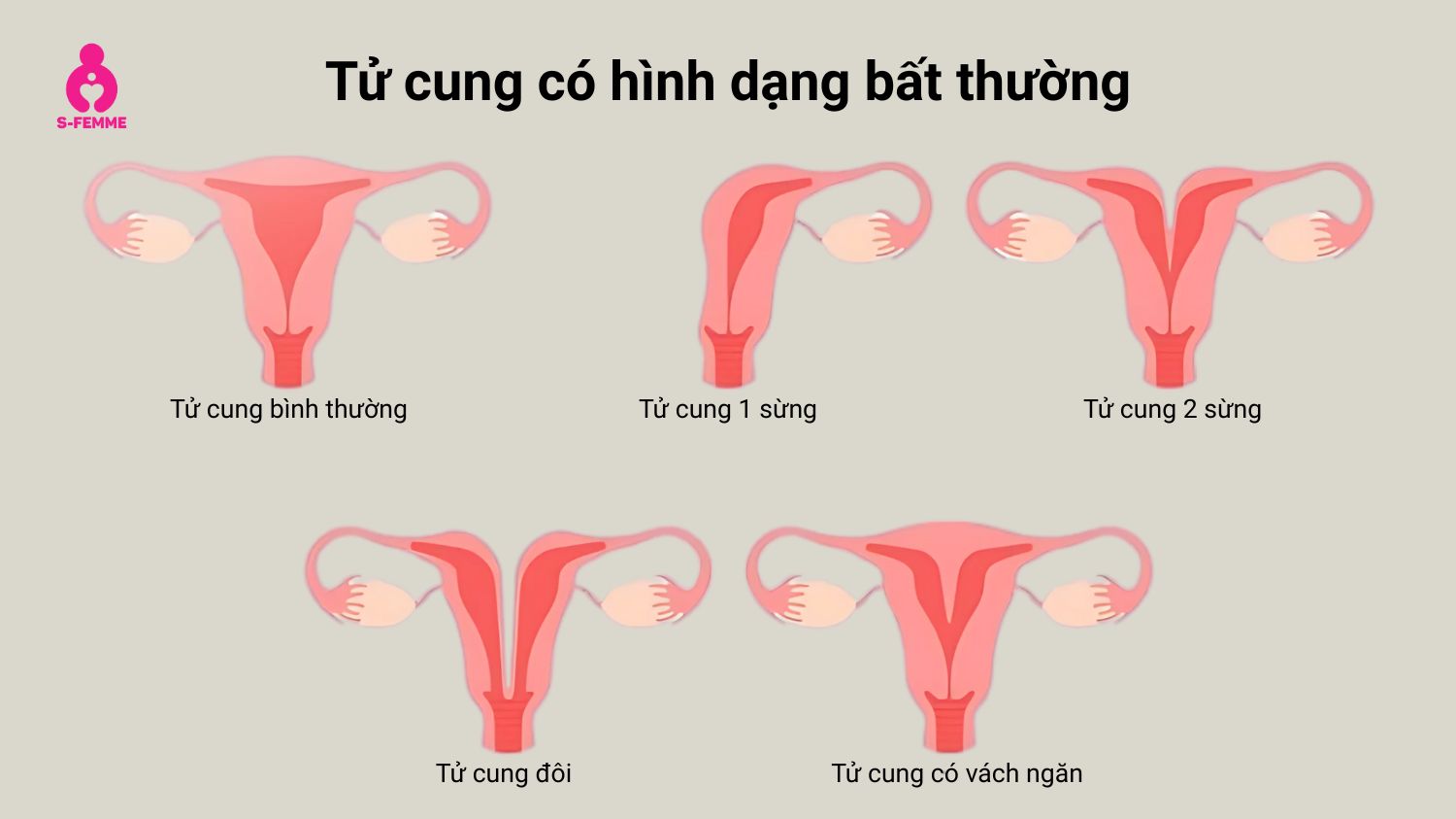 Tử cung có hình dạng bất thường là một trong những nguyên nhân bị vô sinh ở phụ nữ